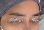 Eyelash Removal