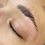 Eyebrow Lifting