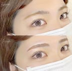 Eyebrow Lifting
