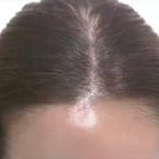 Top Thinning Hair Treatment by Korea Master