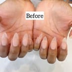 Nail Strengthening Treatment