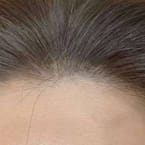 Crown Hair Loss Treatment by Pro Master