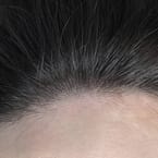 Crown Hair Loss Treatment by Korea Master