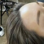 Receding Hairline Treatment by Korea Master