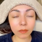 Brow Lift