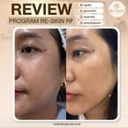 Re-Skin RF Acne Scar Treatment