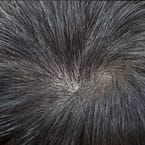 Targeted Hair Density Treatment by Korea Master