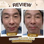 Restylane Filler