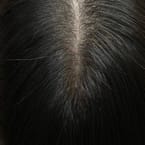 Top Thinning Hair Treatment by Pro Master