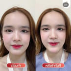 Neuramis Deep Filler