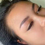 Brow Lifting
