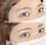 Eyebrow Lifting