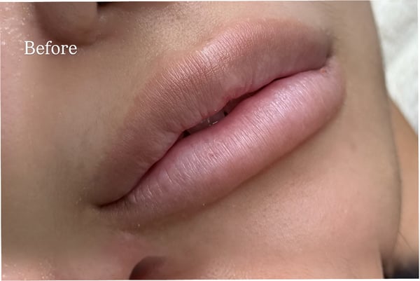 Kove Aesthetic Studio Bangkok 10330 17 - SeeU Beauty