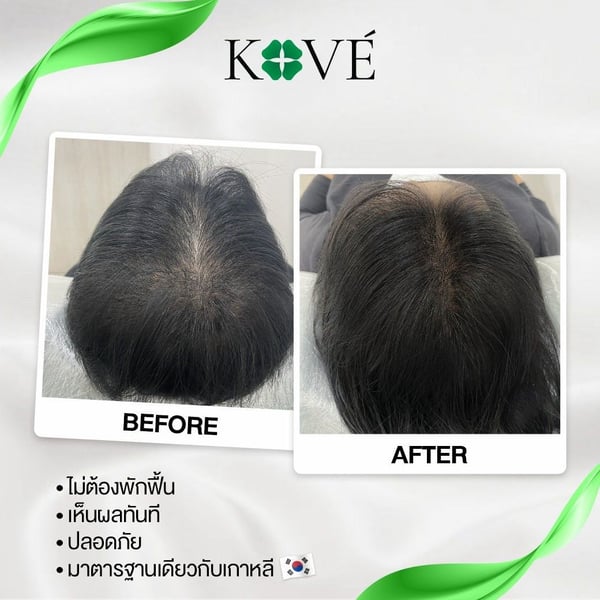 Kove Aesthetic Studio Bangkok 10330 12 - SeeU Beauty